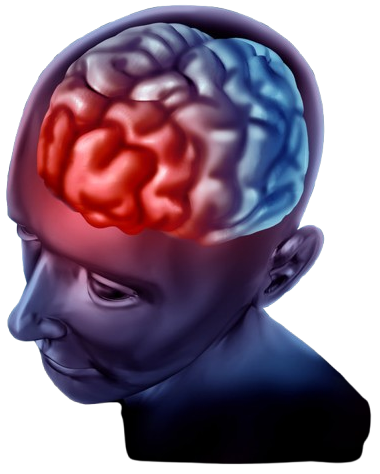 Migraine Headaches Silicon Valley Pain Clinic removebg preview e1770039600988